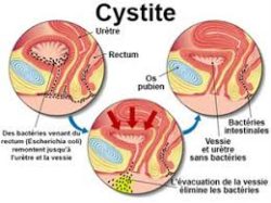 Infection urinaire, conseils et traitements sans ...